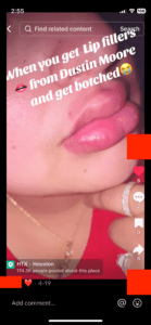 DustinMoore-TikTok-Complaint TikTok screenshot of someone's very swollen mouth with the words "When you get lip fillers from Dustin Moore and get botched"