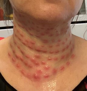 A woman's neck frings with layers of red welts